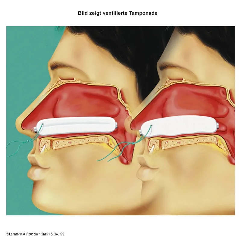 Raucocel Nasentamponaden gerade, ventiliert, mit Faden 80 mm (10 Stck.)